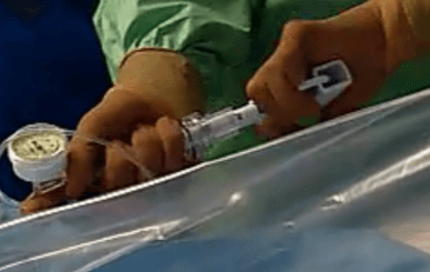 balloon catheter pressure pump