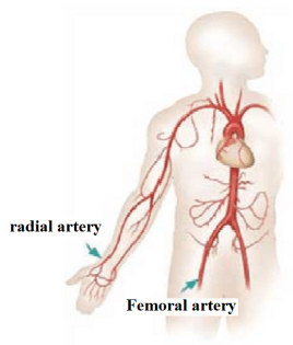 What Is a Transradial Introducer Set?